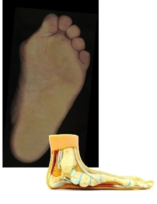 外反母趾の足の画像
